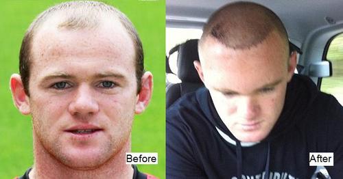 rooney-before-and-after-transplant.jpg